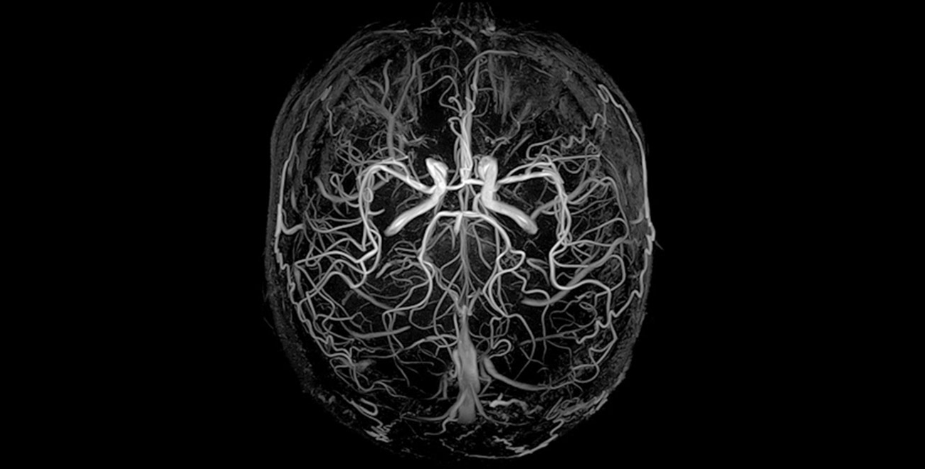 Ангиодистония сосудов. МР венография сосудов головного мозга. Магнитно-резонансная ангиография. Магнитно-резонансная ангиография мозга. Ангиография артерий и вен головного мозга.